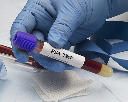 Prostate Cancer And Development Of Biomarkers Prostate Cancer And Development Of Biomarkers