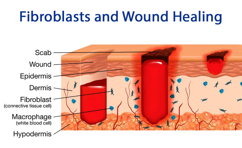 Fibrotic Disease Research Using Dermal Fibroblasts