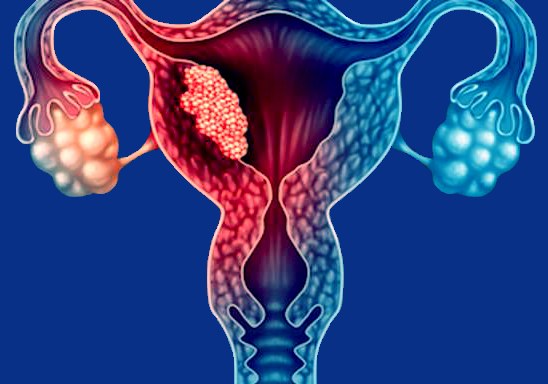 Endometrial cancer blog, Endometrial cancer blog, Tipuri de terapie adjuvantă