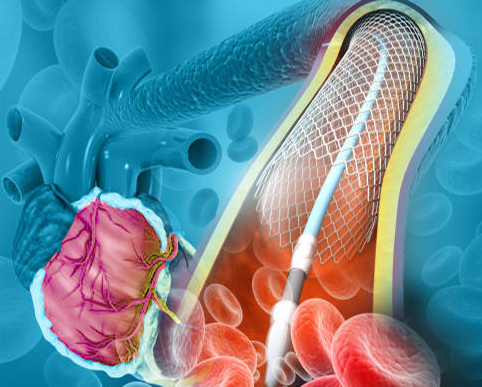 human heart angioplasty