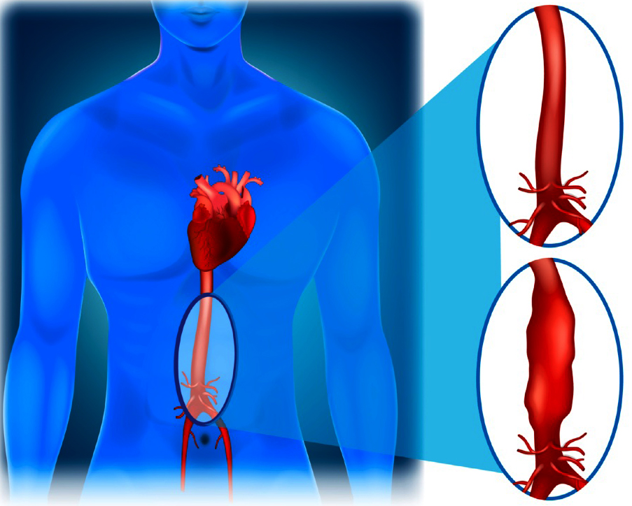 aortic aneurysms blog